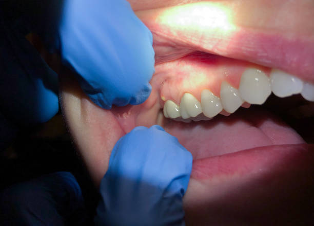 Best Broken Tooth Emergency  in Fitchburg, MA